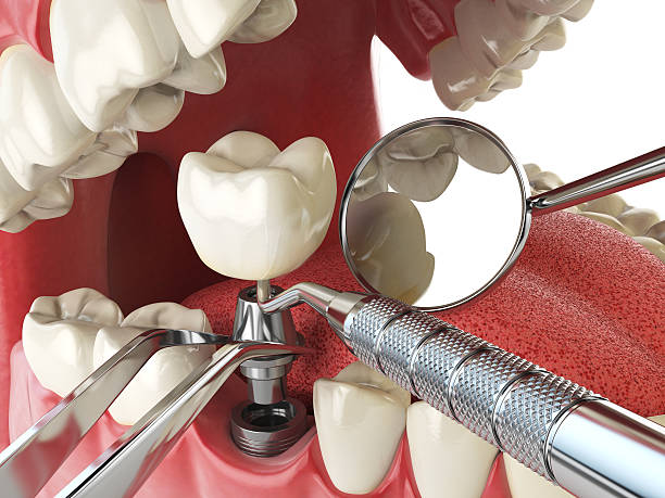 Best Emergency Broken Tooth Repair in Bicknell, IN