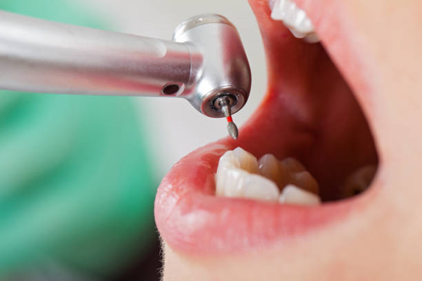 Best Emergency Wisdom Teeth Removal in Bicknell, IN